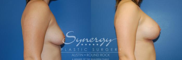 Before & After Breast Augmentation Case 3 View #4 View in Austin, TX