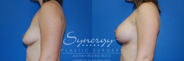 Before & After Breast Augmentation Case 3 View #5 View in Austin, TX