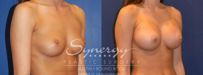 Before & After Breast Augmentation Case 304 View #3 View in Austin, TX