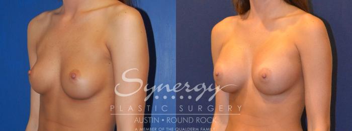 Before & After Breast Augmentation Case 304 View #4 View in Austin, TX