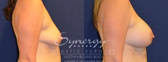 Before & After Breast Augmentation Case 305 View #2 View in Austin, TX