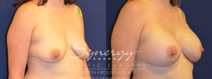 Before & After Breast Augmentation Case 305 View #3 View in Austin, TX