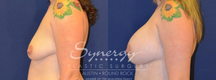 Before & After Breast Augmentation Case 305 View #5 View in Austin, TX