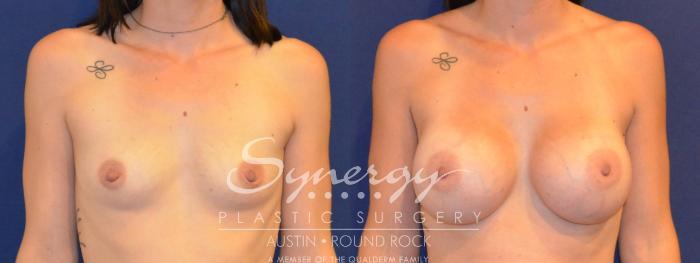 Before & After Breast Augmentation Case 307 View #1 View in Austin, TX