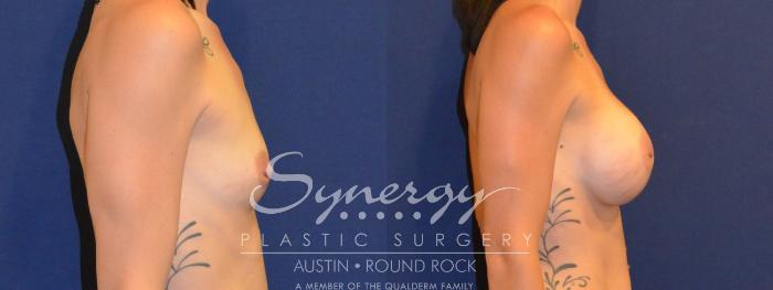 Before & After Breast Augmentation Case 307 View #2 View in Austin, TX