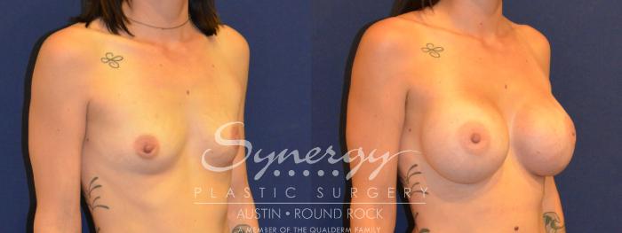 Before & After Breast Augmentation Case 307 View #3 View in Austin, TX