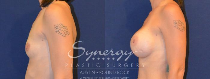 Before & After Breast Augmentation Case 307 View #4 View in Austin, TX