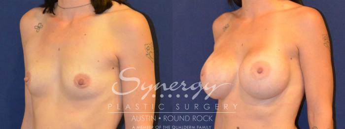 Before & After Breast Augmentation Case 307 View #5 View in Austin, TX