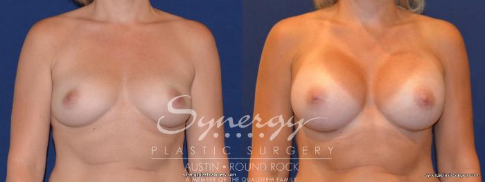 Before & After Breast Augmentation Case 311 View #1 View in Austin, TX