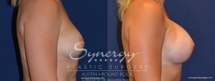 Before & After Breast Augmentation Case 311 View #2 View in Austin, TX