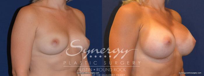 Before & After Breast Augmentation Case 311 View #3 View in Austin, TX