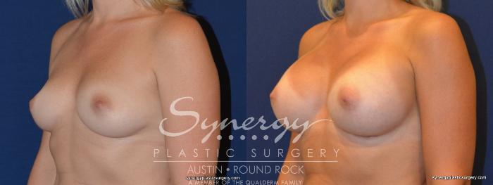 Before & After Breast Augmentation Case 311 View #4 View in Austin, TX