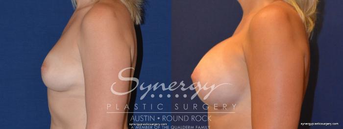 Before & After Breast Augmentation Case 311 View #5 View in Austin, TX