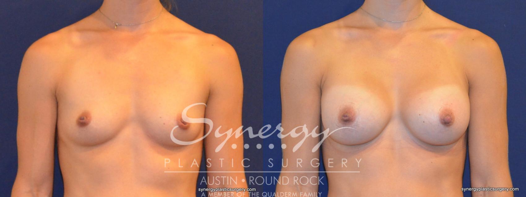 Before & After Breast Augmentation Case 312 View #1 View in Austin, TX