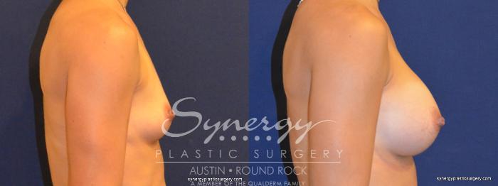 Before & After Breast Augmentation Case 312 View #2 View in Austin, TX