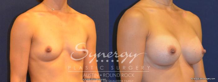 Before & After Breast Augmentation Case 312 View #3 View in Austin, TX