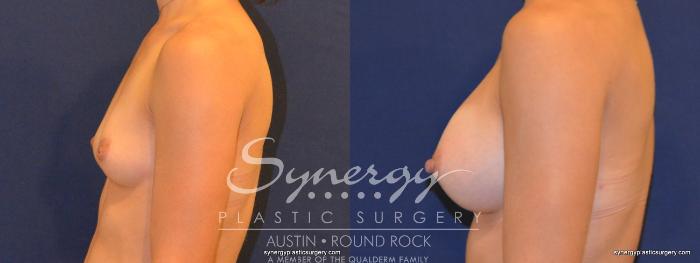 Before & After Breast Augmentation Case 312 View #4 View in Austin, TX