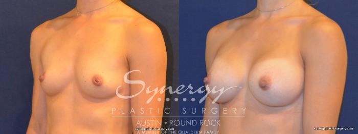 Before & After Breast Augmentation Case 312 View #5 View in Austin, TX
