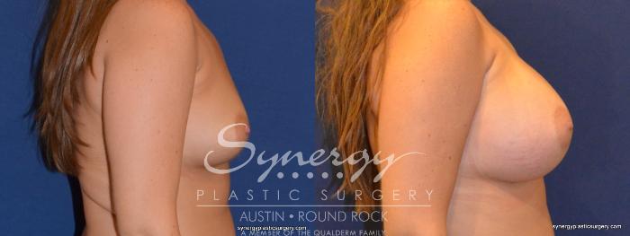Before & After Breast Augmentation Case 313 View #2 View in Austin, TX