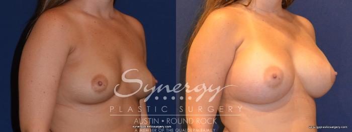 Before & After Breast Augmentation Case 313 View #3 View in Austin, TX