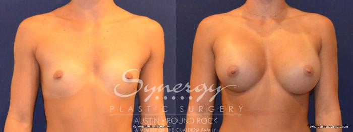 Before & After Breast Augmentation Case 314 View #1 View in Austin, TX