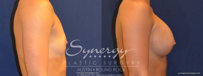 Before & After Breast Augmentation Case 314 View #2 View in Austin, TX
