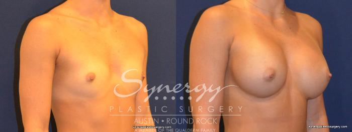 Before & After Breast Augmentation Case 314 View #3 View in Austin, TX