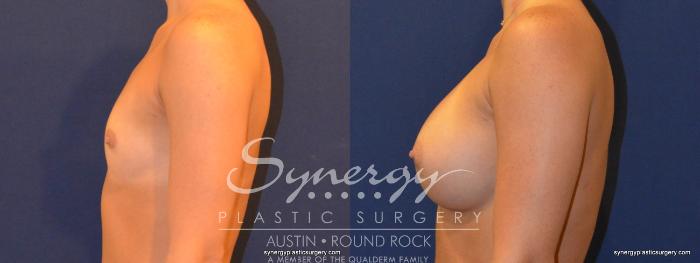 Before & After Breast Augmentation Case 314 View #4 View in Austin, TX