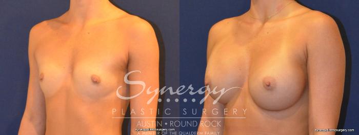 Before & After Breast Augmentation Case 314 View #5 View in Austin, TX