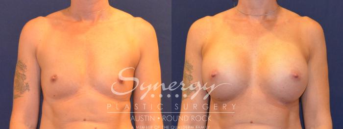 Before & After Breast Augmentation Case 317 View #1 View in Austin, TX