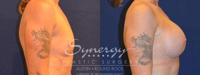 Before & After Breast Augmentation Case 317 View #2 View in Austin, TX