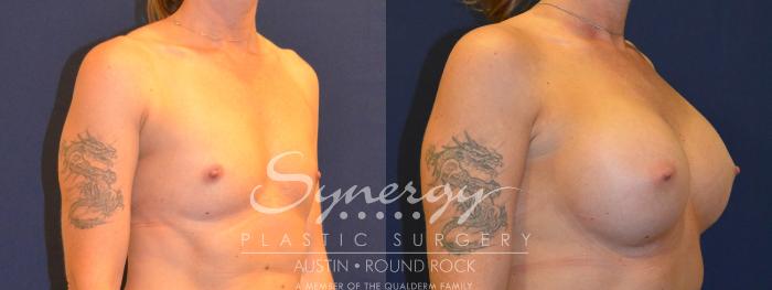 Before & After Breast Augmentation Case 317 View #3 View in Austin, TX