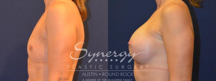Before & After Breast Augmentation Case 317 View #4 View in Austin, TX