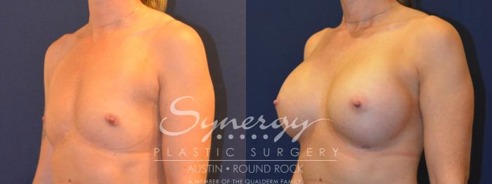 Before & After Breast Augmentation Case 317 View #5 View in Austin, TX