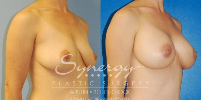 Before & After Breast Augmentation Case 32 View #5 View in Austin, TX