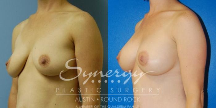 Before & After Breast Augmentation Case 32 View #7 View in Austin, TX