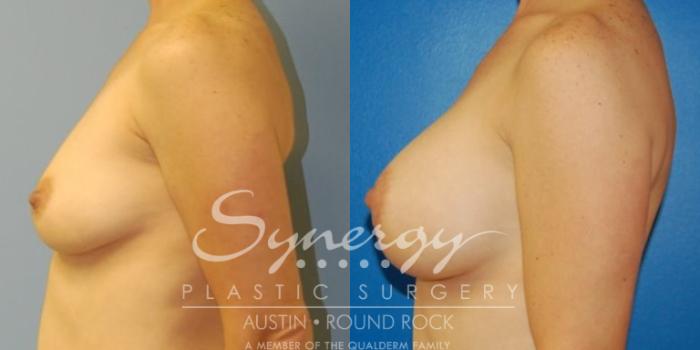 Before & After Breast Augmentation Case 32 View #8 View in Austin, TX