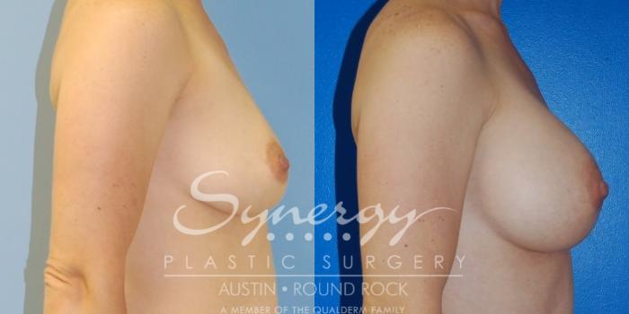 Before & After Breast Augmentation Case 32 View #9 View in Austin, TX