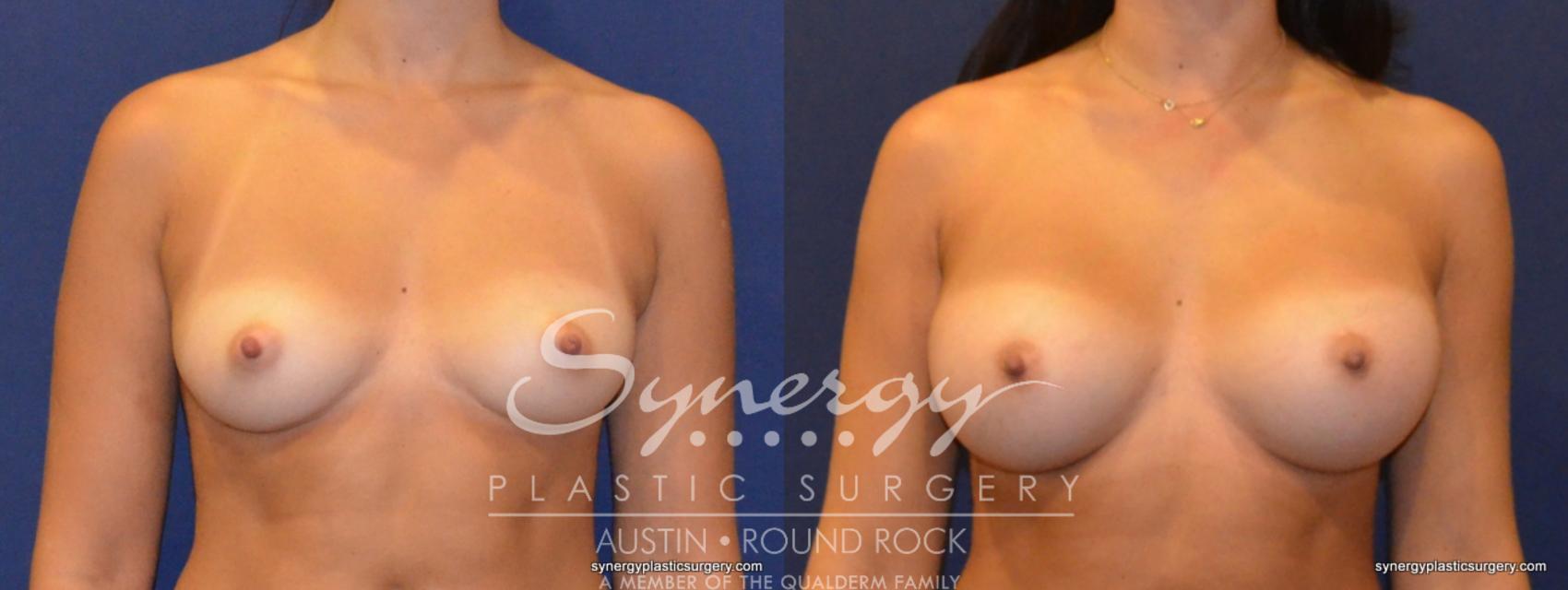 Before & After Breast Augmentation Case 321 View #1 View in Austin, TX