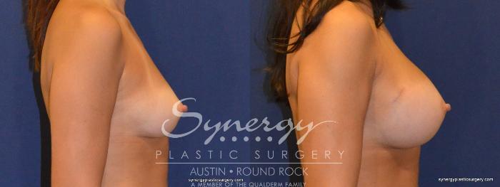 Before & After Breast Augmentation Case 321 View #2 View in Austin, TX