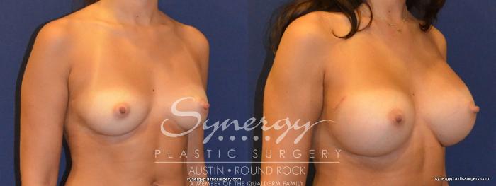 Before & After Breast Augmentation Case 321 View #3 View in Austin, TX