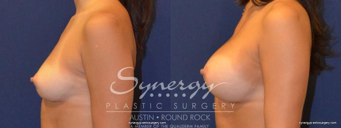 Before & After Breast Augmentation Case 321 View #4 View in Austin, TX