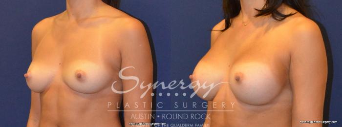 Before & After Breast Augmentation Case 321 View #5 View in Austin, TX