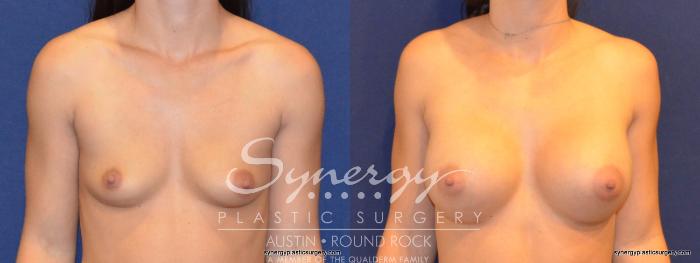 Before & After Breast Augmentation Case 322 View #1 View in Austin, TX