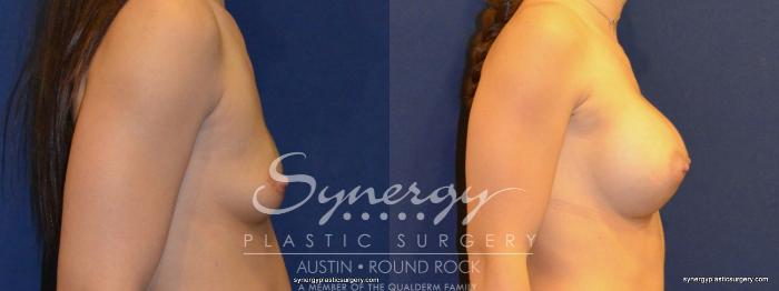 Before & After Breast Augmentation Case 322 View #3 View in Austin, TX