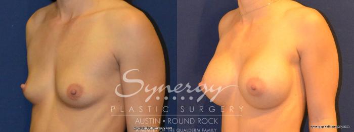 Before & After Breast Augmentation Case 322 View #4 View in Austin, TX
