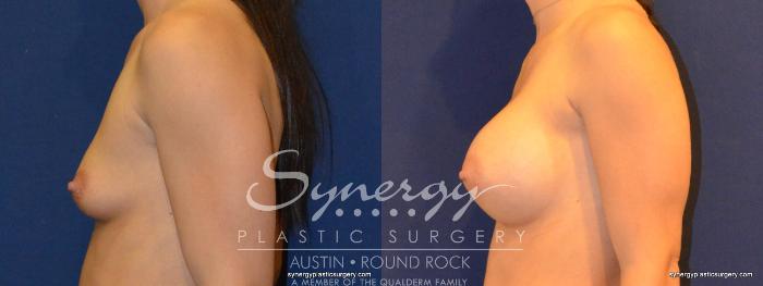 Before & After Breast Augmentation Case 322 View #5 View in Austin, TX