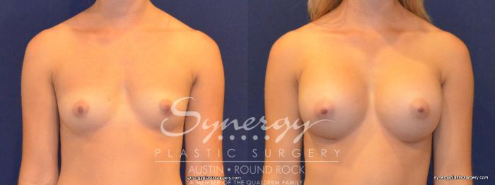 Before & After Breast Augmentation Case 327 View #1 View in Austin, TX