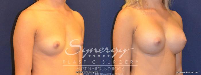Before & After Breast Augmentation Case 327 View #2 View in Austin, TX