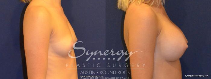 Before & After Breast Augmentation Case 327 View #3 View in Austin, TX